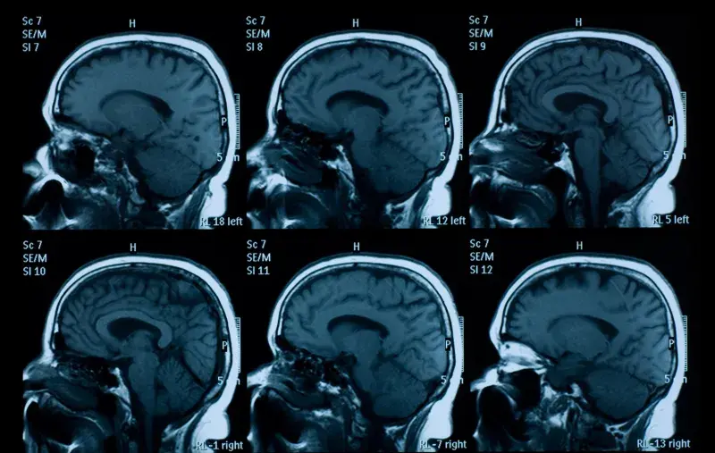 MRI of human brain