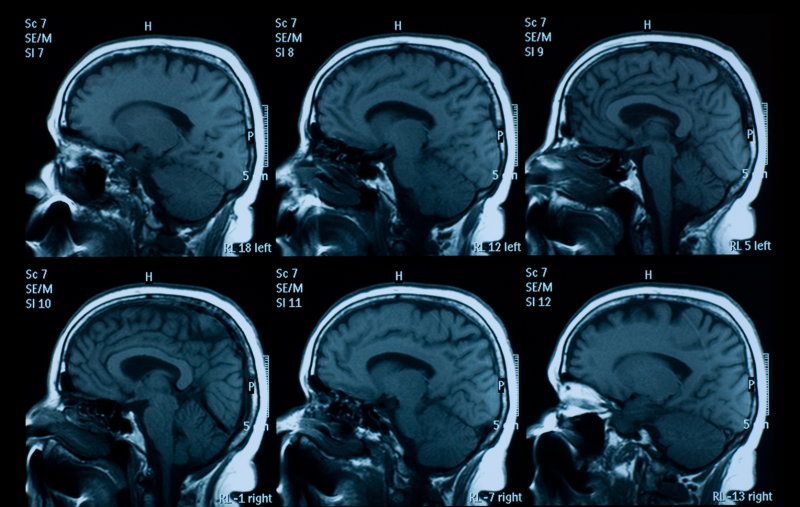 MRI of human brain