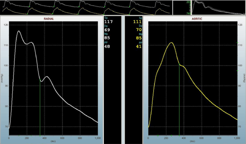 Jim's pulse wave analysis
